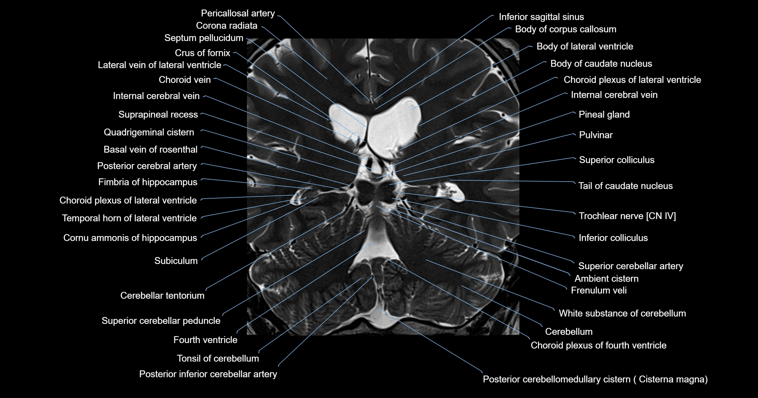 MRI brainstem & basal ganglia anatomy labelled 3T MRI images -img-00001-00030.webp